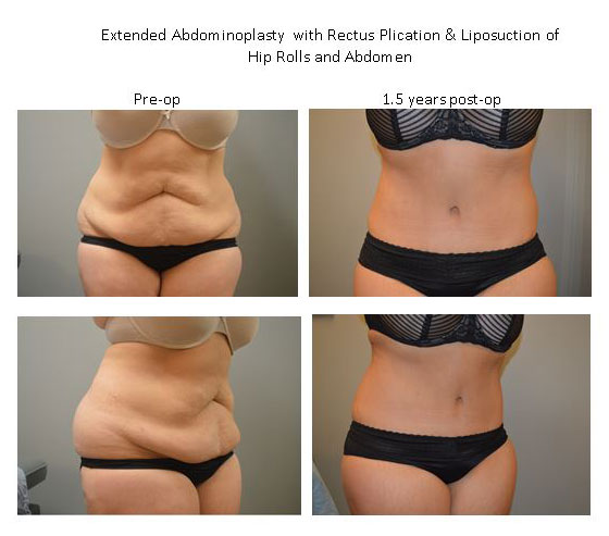 Week 2 post op follow up after double reverse abdominoplasty for isola